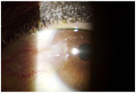 Pterygium
