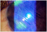 Corneal Scratch