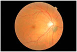 Mole on Retina