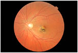 Scar on Macula