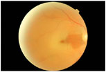 Retinal Artery Occlusion