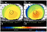 Corneal Map