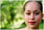 Skin Outgrowths Removed by Radio-Surgery