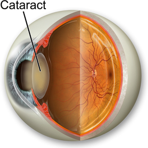 Cataract Diagram