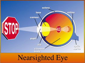 Eye anotomy- Near sighted Eye