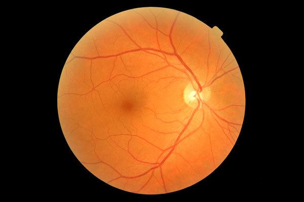 Glaucoma Normal Eye