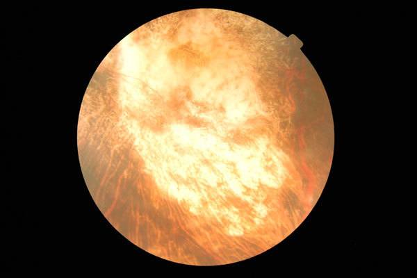 Macular Degeneration #1