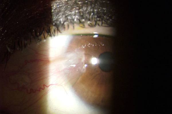 Pterygium eye pic