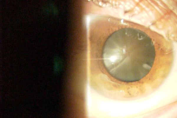 Eye with Cataract