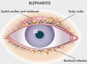 Blepharitis