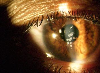 Corneal Dystophy