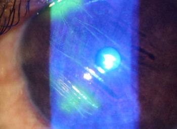 Corneal Scratch