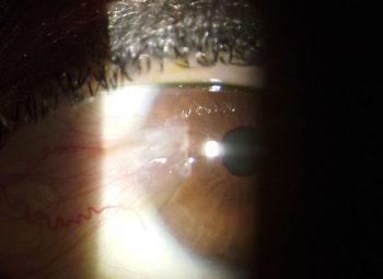 Pterygium in Eye