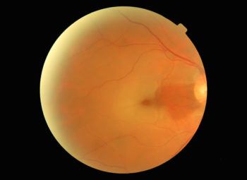 Retinal Artery Occlusion