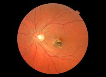 Scar on Macula
