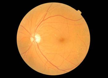 Early Diabetic Retinopthy with Microhemorrhages
