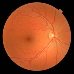 Diabetic Retinopathy Normal Retina