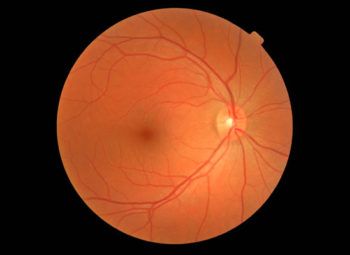 Diabetic Retinopathy Normal Retina