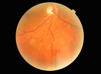 Diabetic retinopathy Retina with early PDR