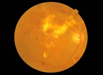 Diabetic retinopathy with advanced PDR