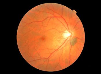 Mole on Retina