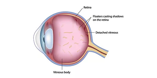 Floaters in Eye Diagram