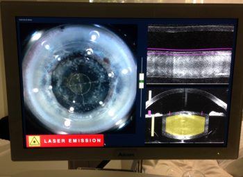 Laser Assisted Cataract Surgery