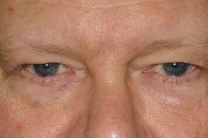 eyes before eyelid surgery