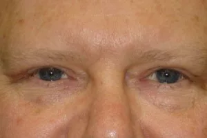 eyes after eyelid surgery