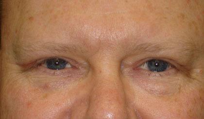 eyes after eyelid surgery