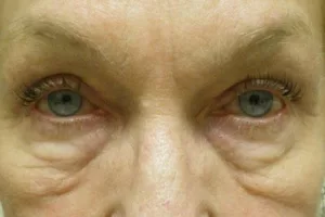 Skin under eyelids before surgery