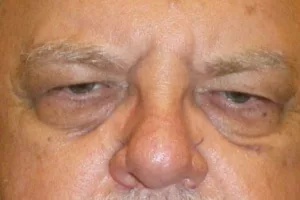Eyelid surgery patient before
