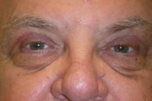 Eyelid surgery patient