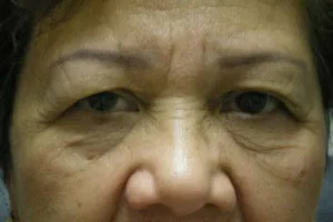 eyelid surgery before