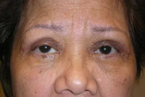 Eyelid surgery after