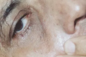 Close up of eye and eyelid