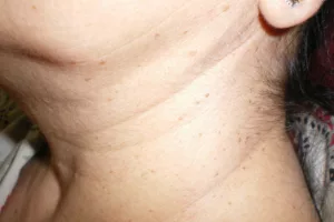 Skin tags needing removal