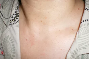 skin imperfections on neck