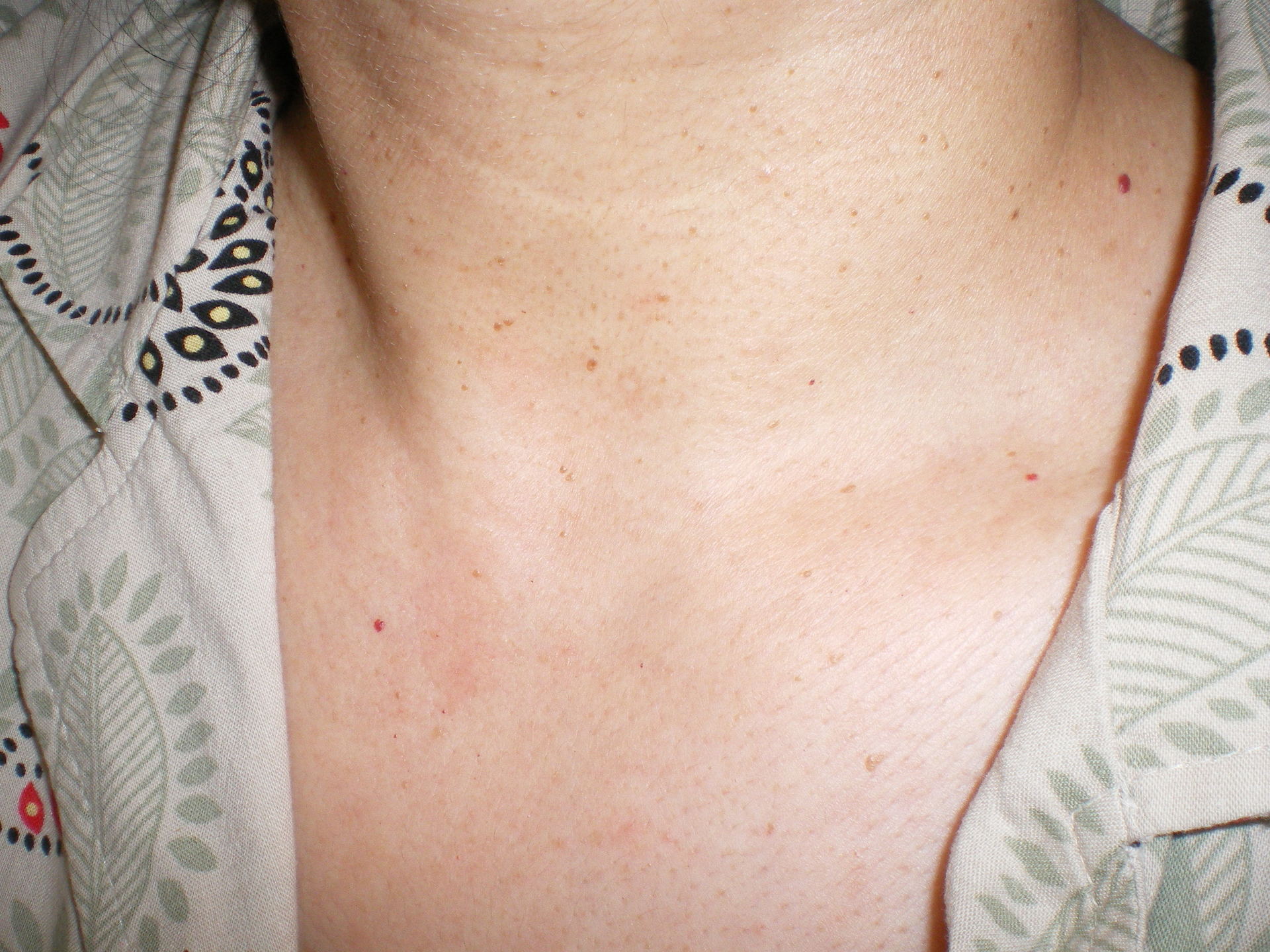 skin imperfections on neck