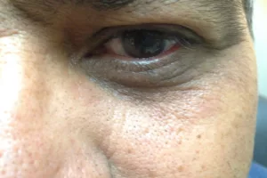 Eyelid needing surgery