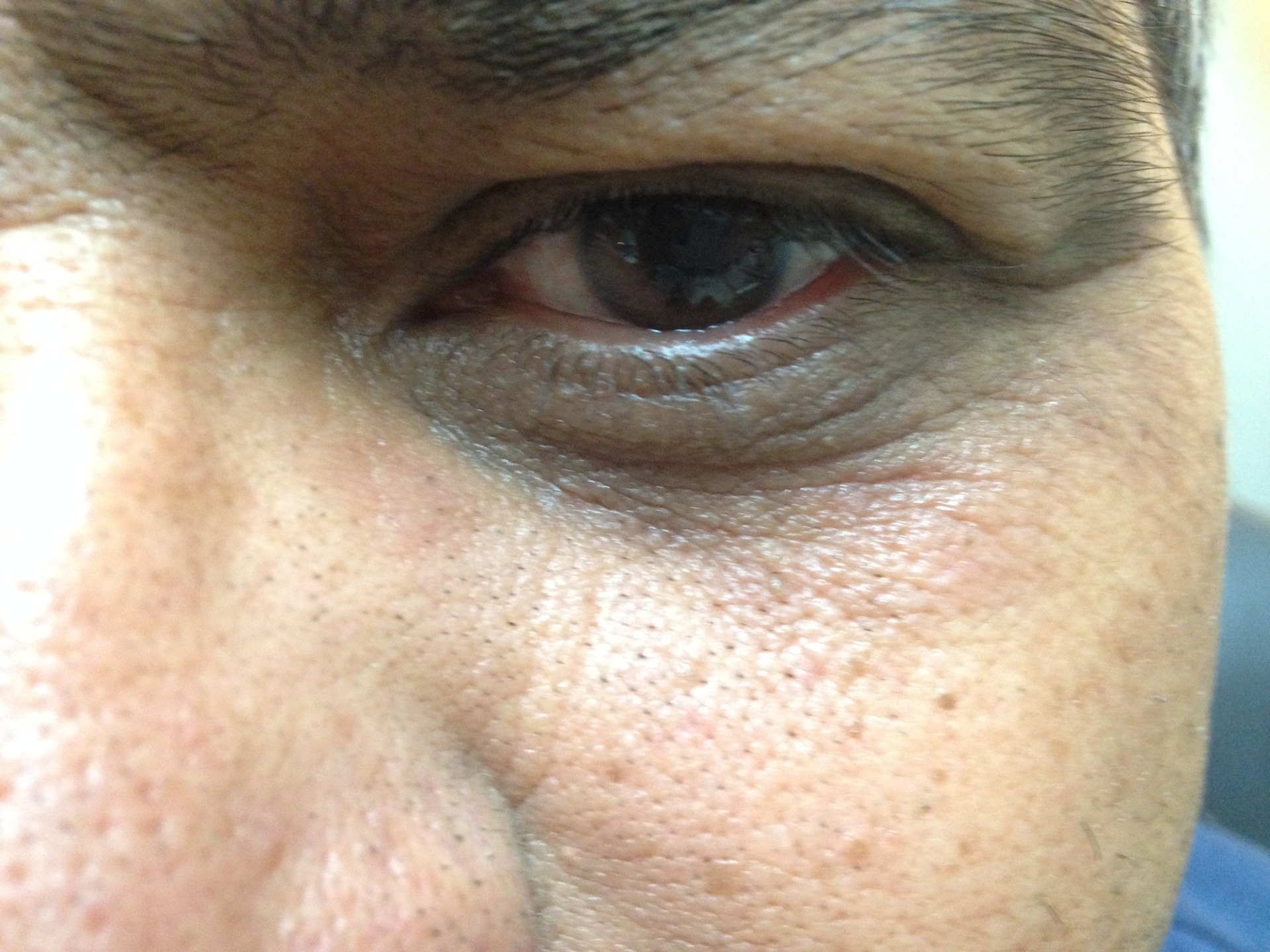 Eyelid needing surgery