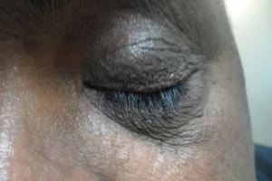 Eyelid with wrinkles
