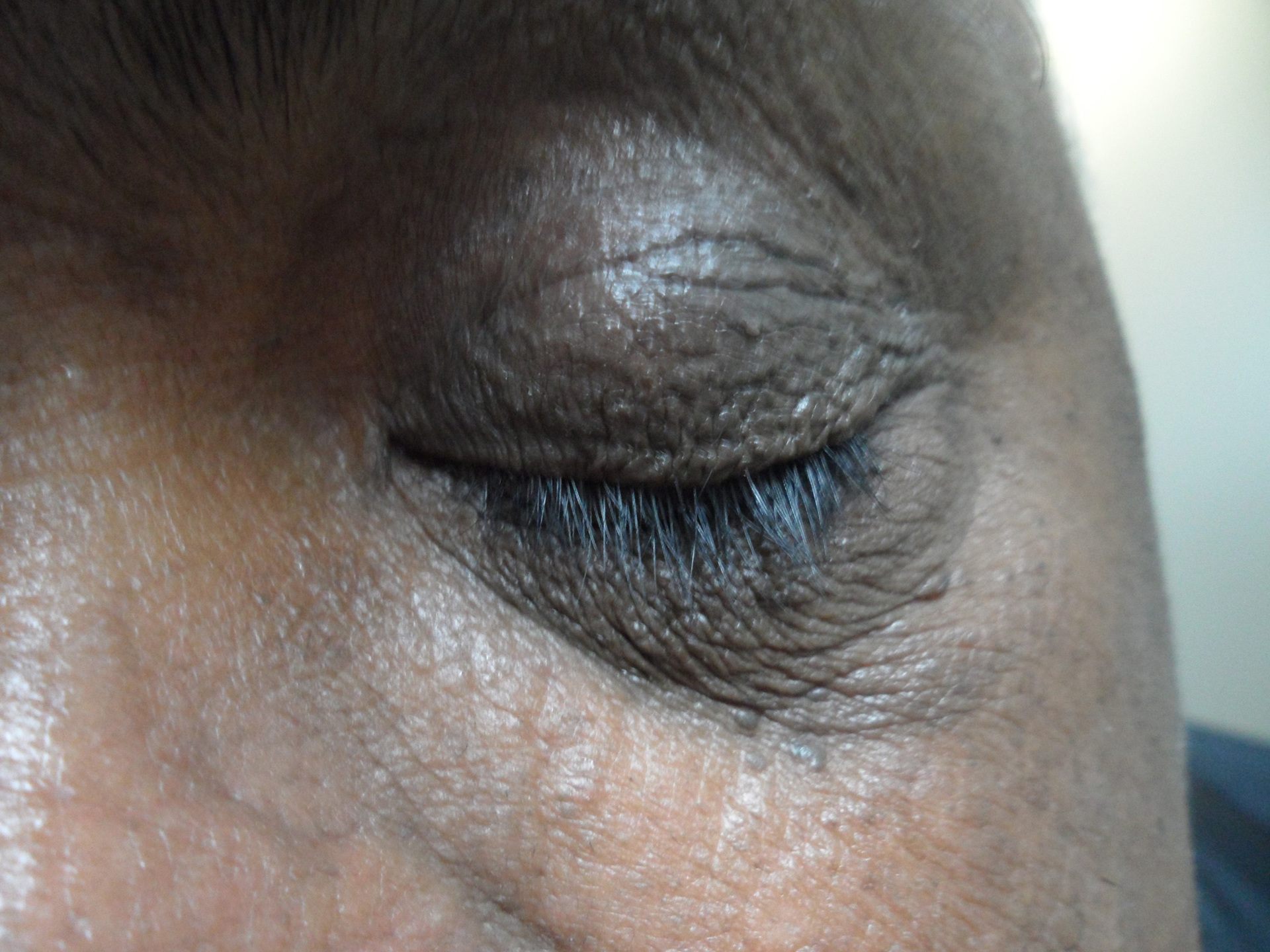 Eyelid with wrinkles