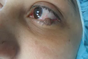 Eyelid needing treatment