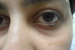 Close up of unhealthy eye
