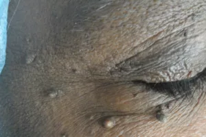 Skin imperfections near eye