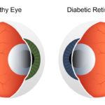 Diabetic Retinopathy