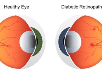 Diabetic Retinopathy