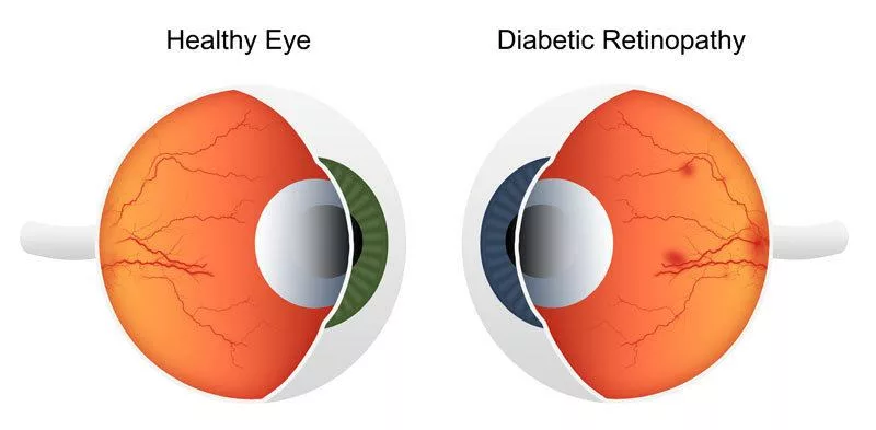 Diabetic Retinopathy