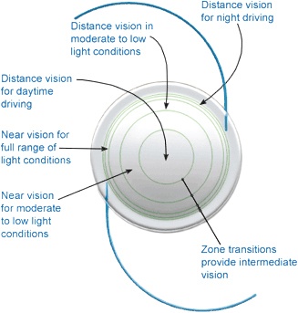 Multifocal Implant Focus Zones